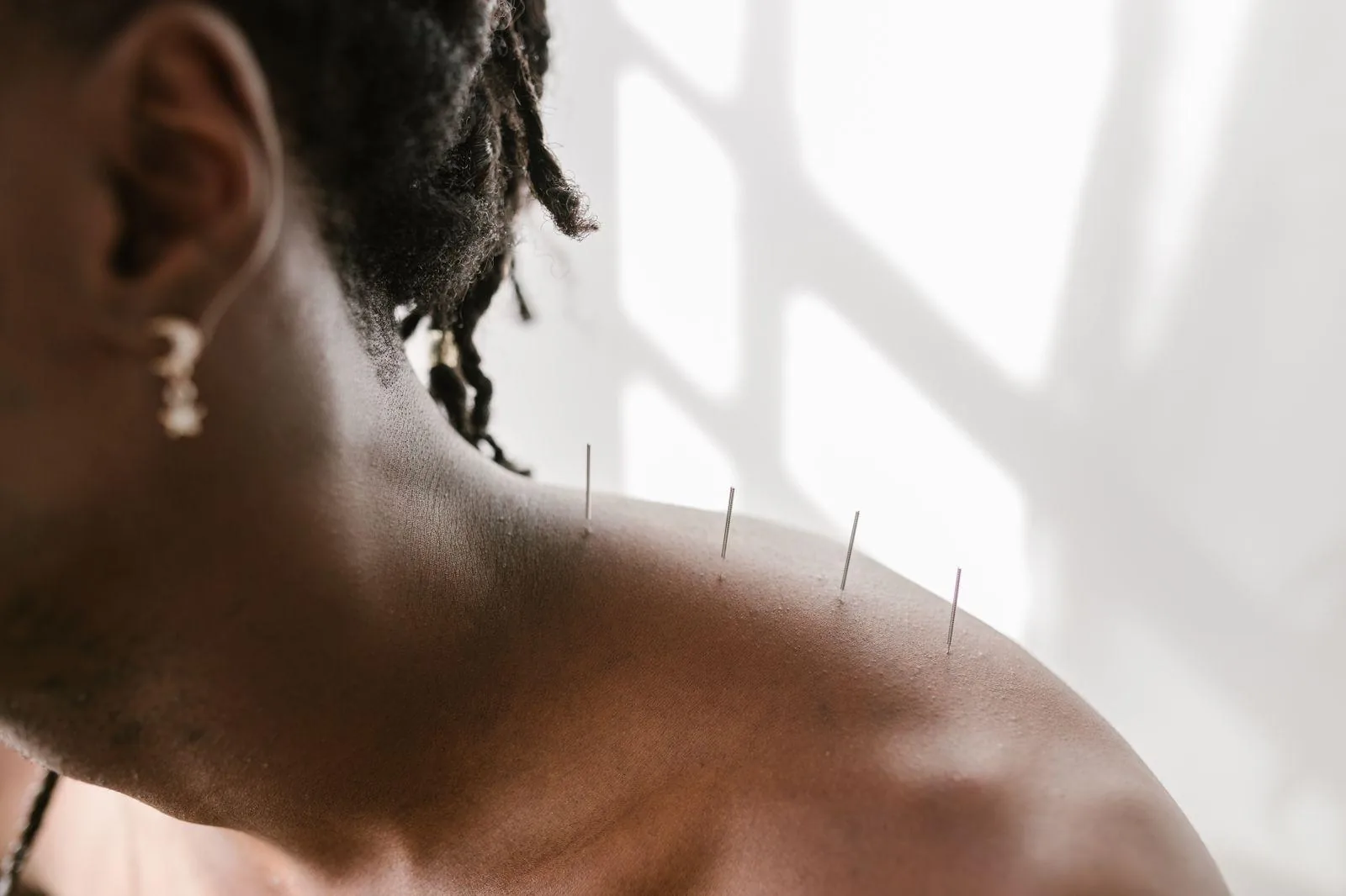 Dry needling needles placed along a patient's neck and shoulder