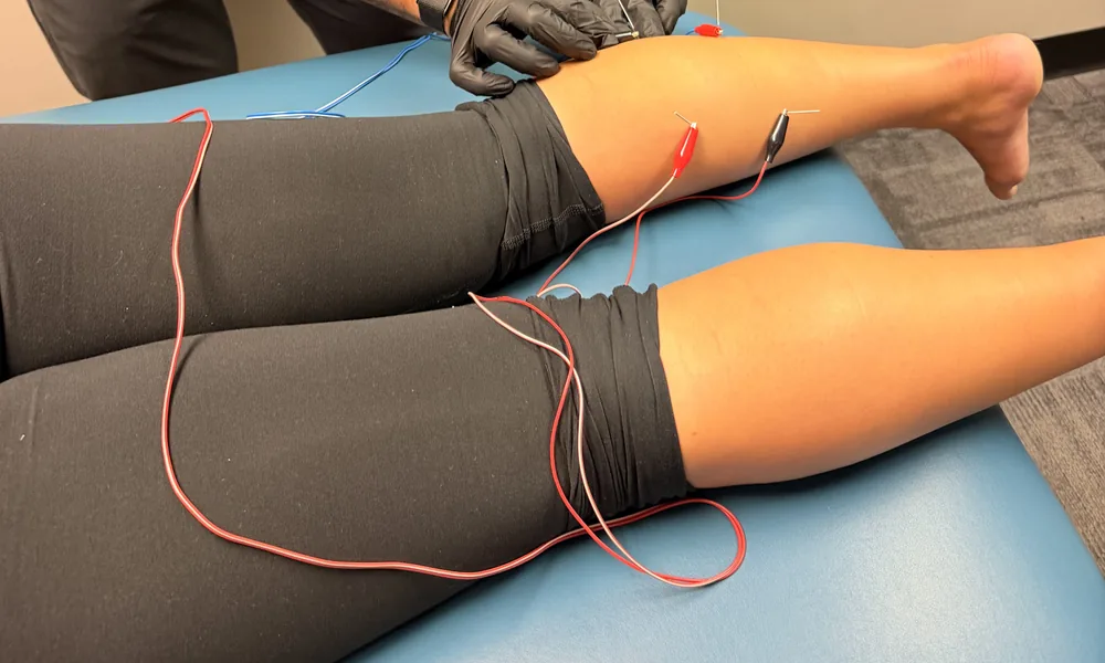 Thin clips from a STIM unit attached to dry needles in a patient’s calf